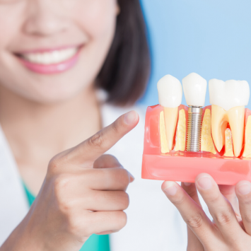 Understanding Teeth Implants