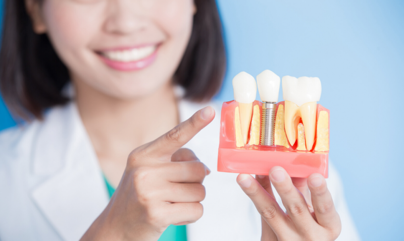 Understanding Teeth Implants