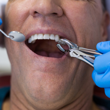 What to Know About Tooth Extraction