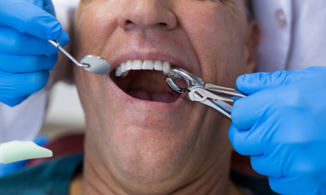 What to Know About Tooth Extraction